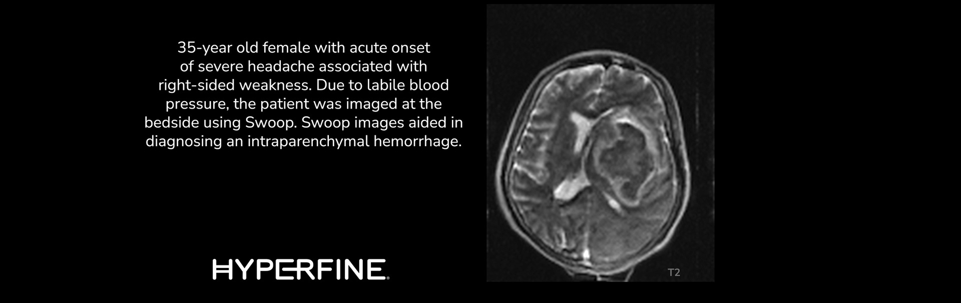 Hemorrhage Clinical Images