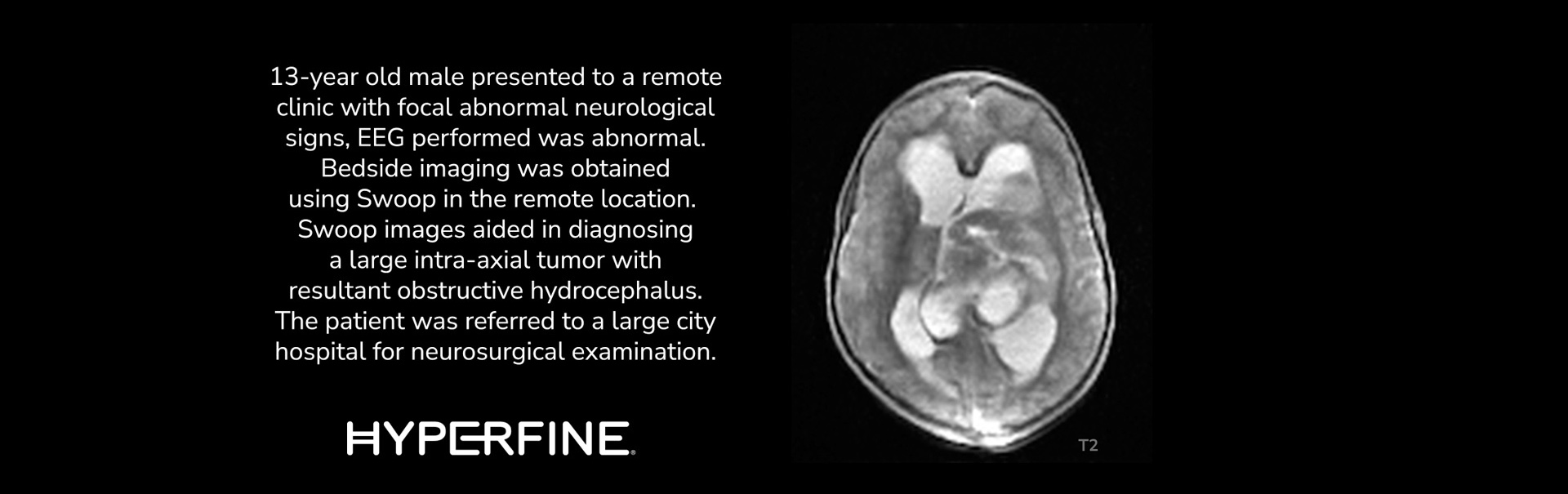 Hydrocephalus Clinical Images