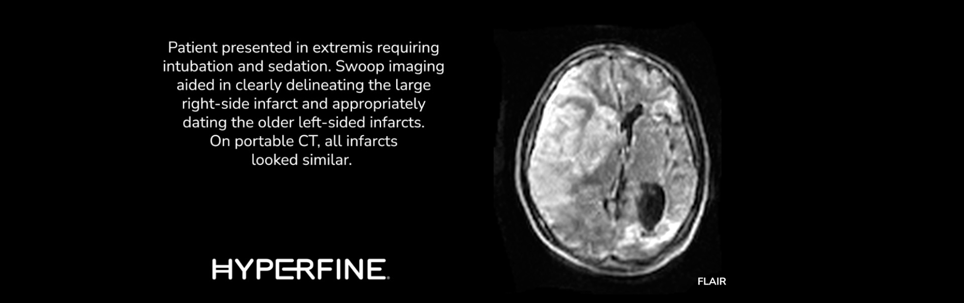 Infarct Clinical Images