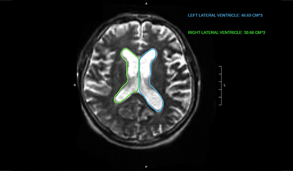 BrainInsight<sup><sub>™</sub></sup>—automated AI tools.